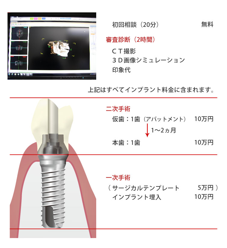 インプラント価格